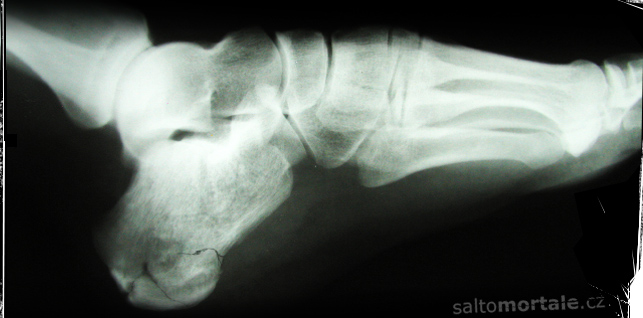free running accident in morocco - broken bone, fracture